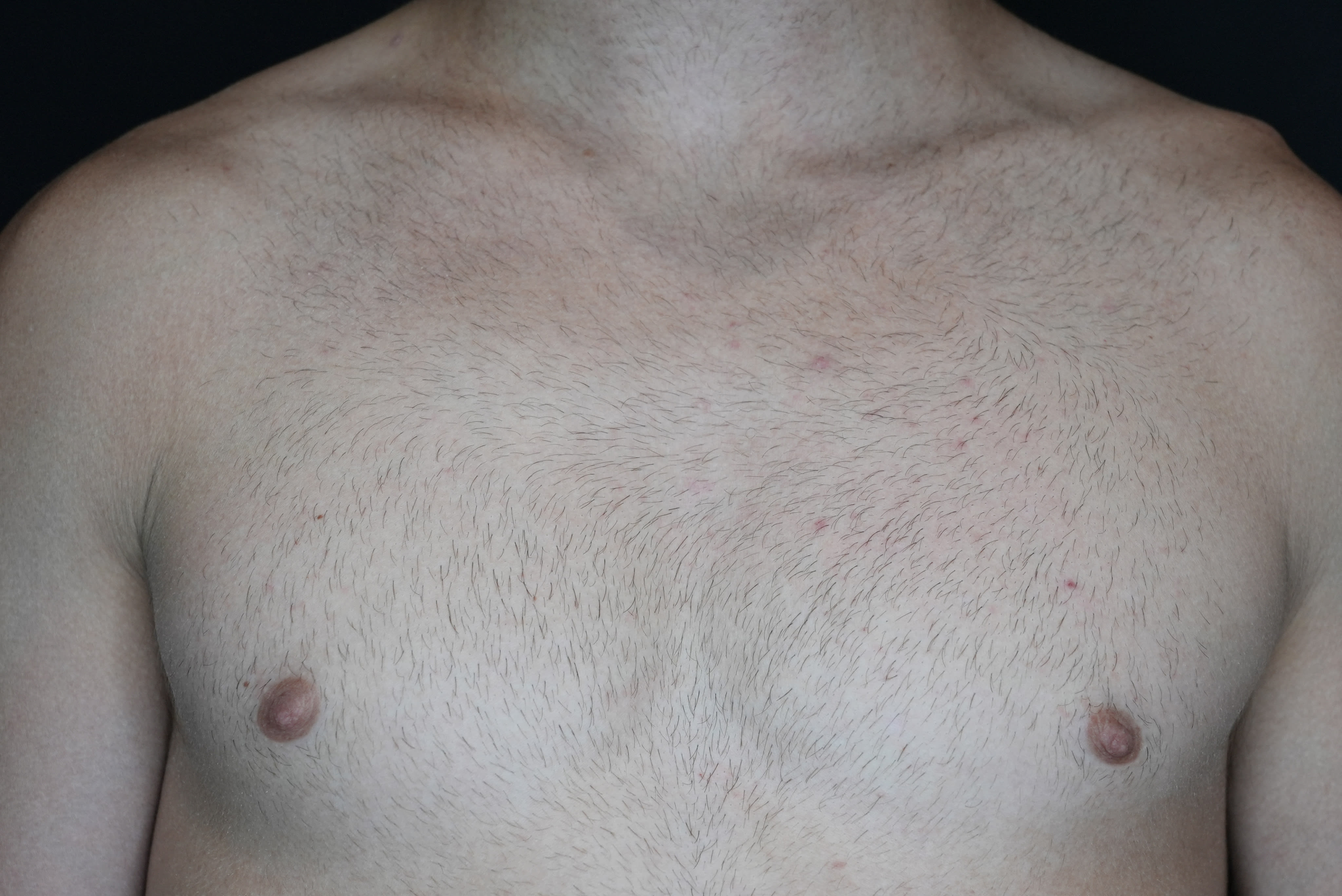 Laser hair removal chest before treatment